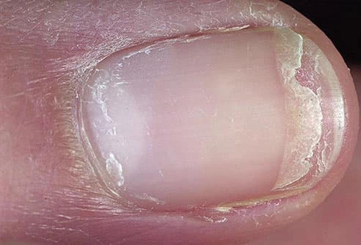 Cracked or Split Nails Cracked or Split Nails