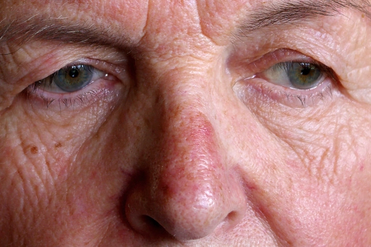 Red Nose: Rosacea
