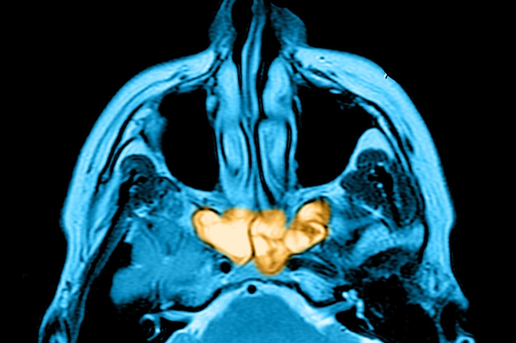 Phantom Smell: Sinus Infection