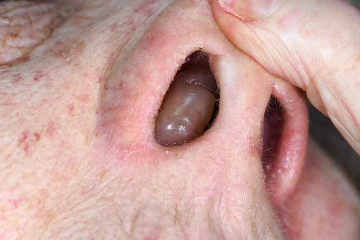 Decreased Sense of Smell: Polyps Decreased Sense of Smell: Polyps