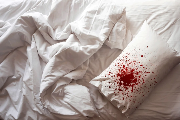 Nosebleeds: Hereditary Hemorrhagic Telangiectasia
