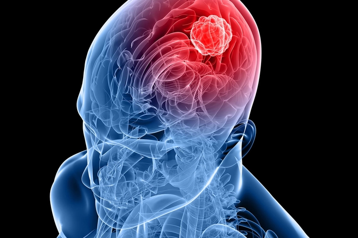 Phantom Smell: Brain Disorder