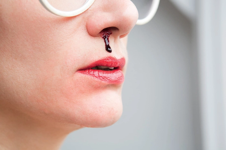 Nosebleeds: Other Causes