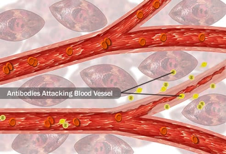 Vasculitis