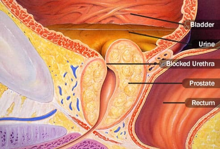 Blockage Blockage