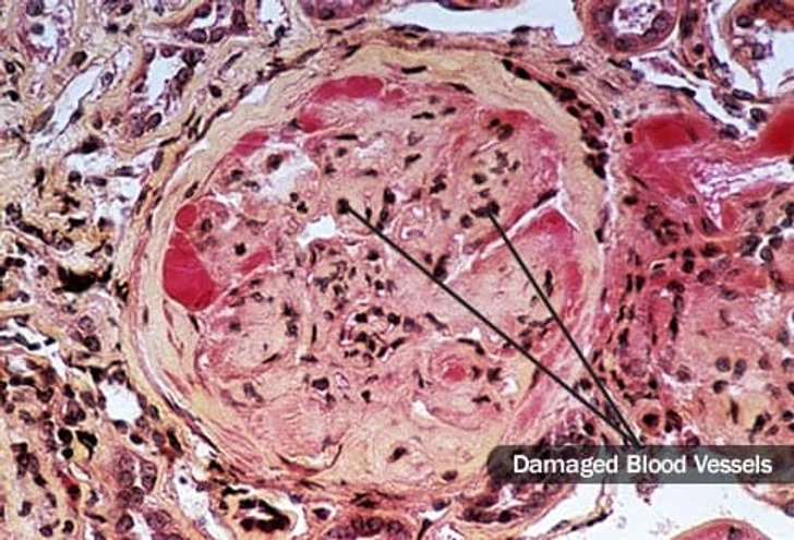 Diabetic Kidney Disease