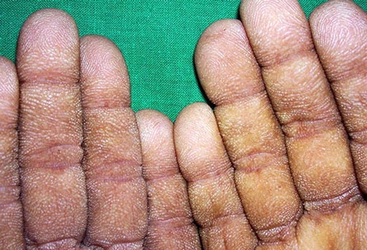 Tripe Palms