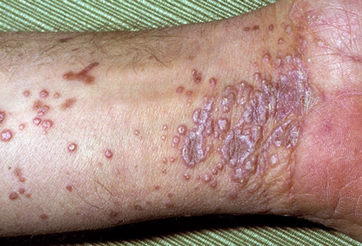 Itchy, Violet Bumps on Wrist