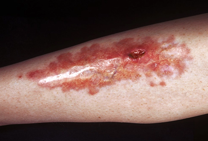 Leg Plaque: Red on Edge, Gold in Center Leg Plaque: Red on Edge, Gold in Center