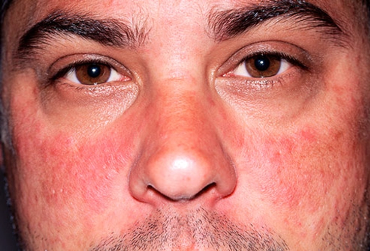 Butterfly Rash