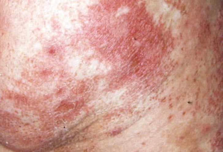 Scaly Rash on Buttocks, Red Tongue Scaly Rash on Buttocks, Red Tongue