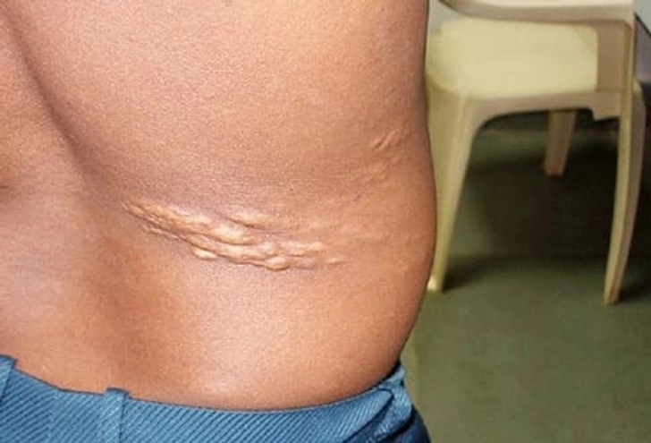 Flesh Colored, Orange-Peel Patches on Back