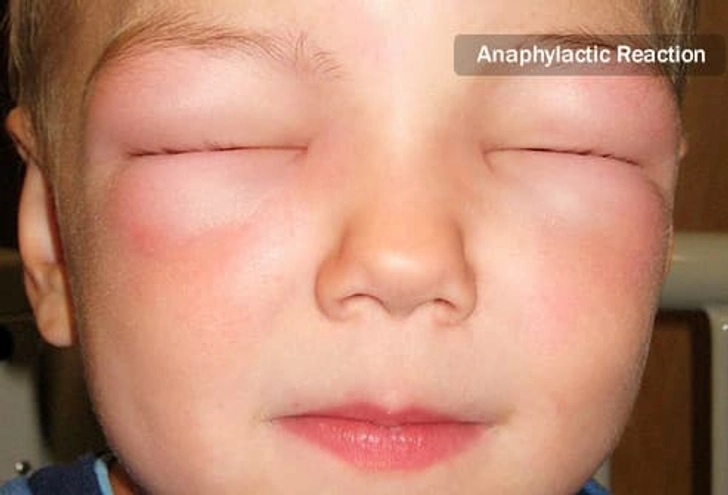 Intolerance or Allergy? Intolerance or Allergy?