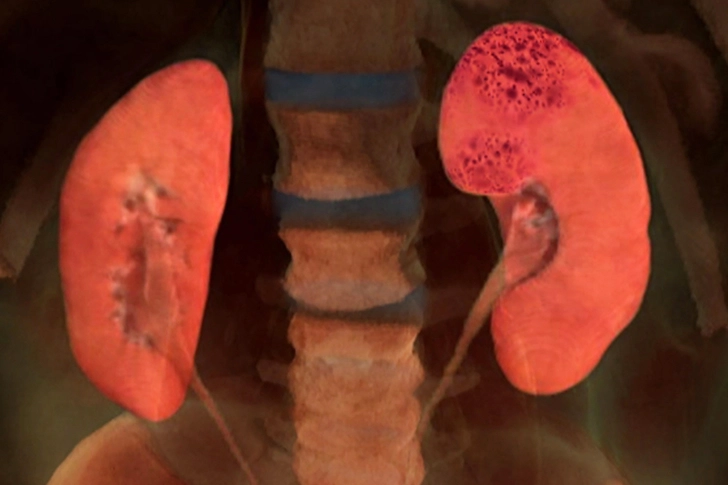 Kidney Failure