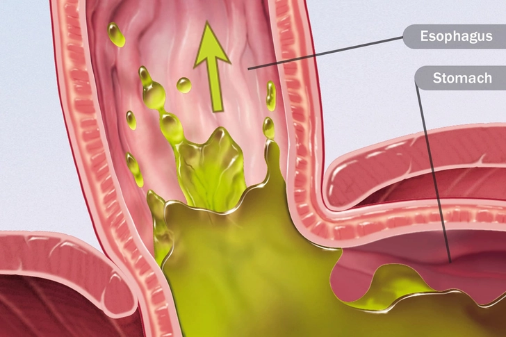 Acid Reflux