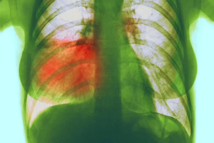 Pneumonia