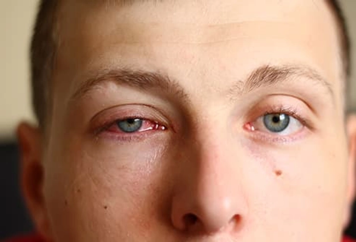 Conjunctivitis