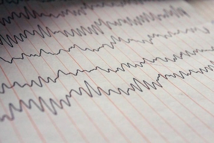 Epilepsy