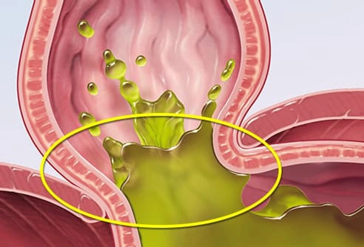Hiatal Hernia