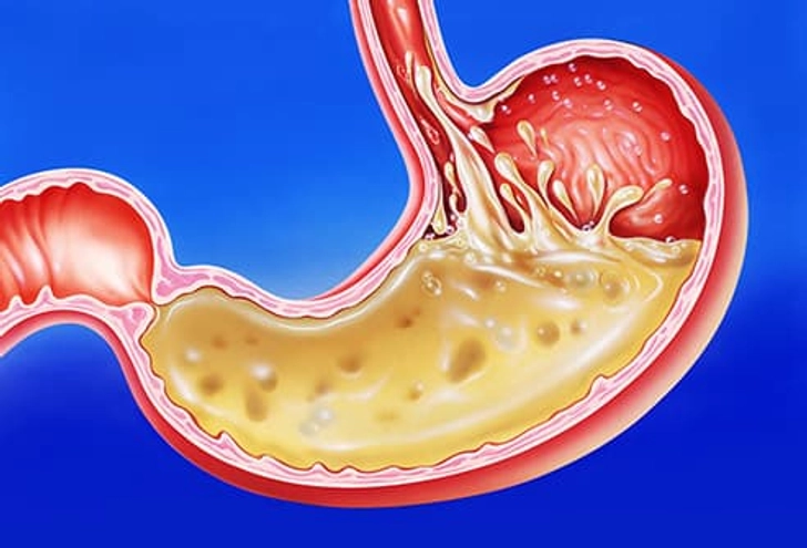 Acid Reflux