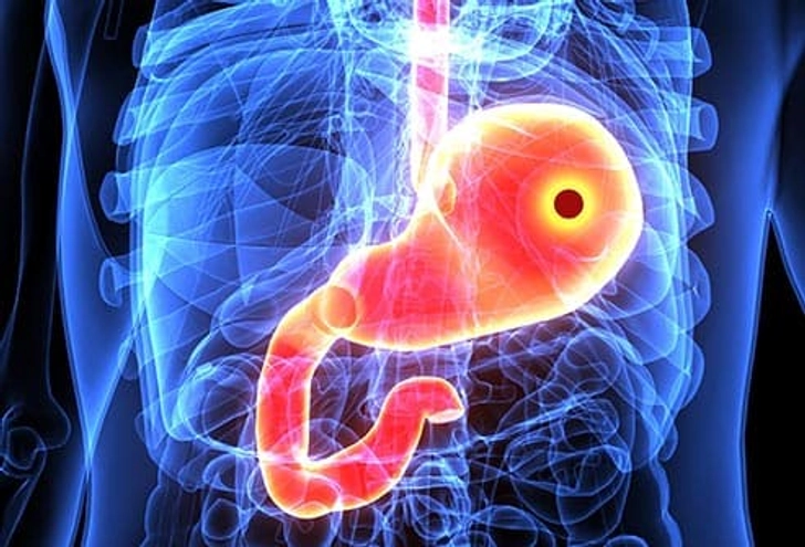 Ulcers