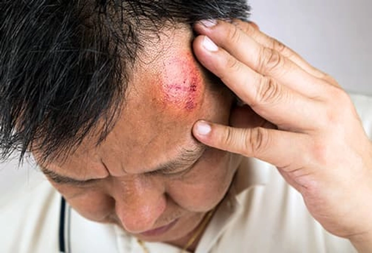 Head Injury Head Injury