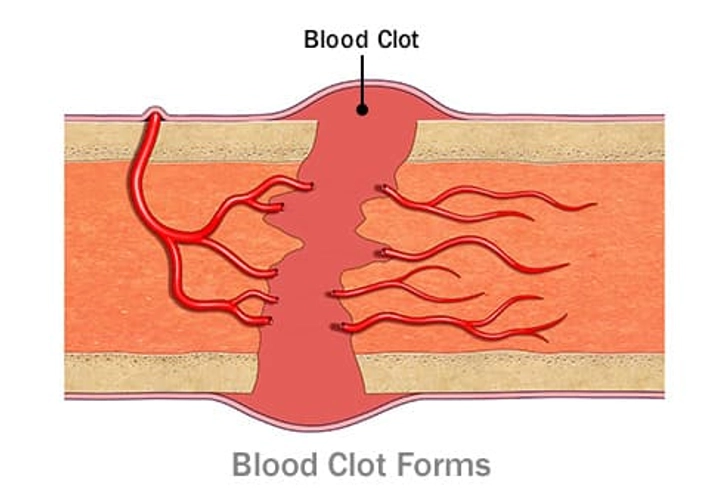 Bone Repair: Step 1