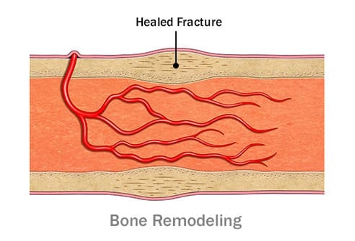 Bone Repair: Step 4 Bone Repair: Step 4