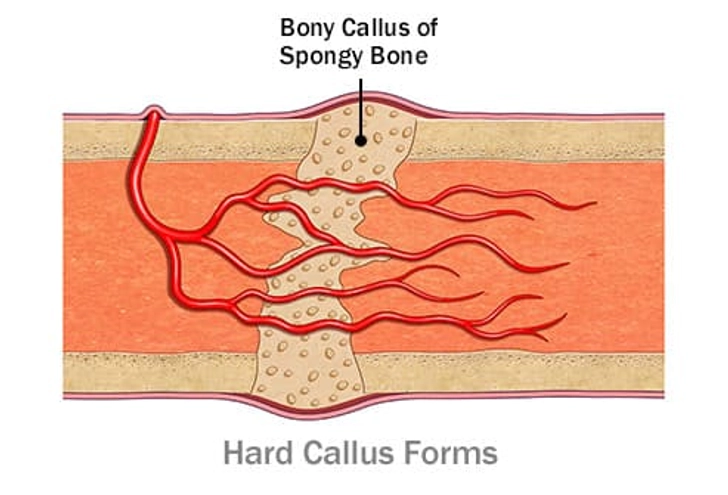 Bone Repair: Step 3 Bone Repair: Step 3