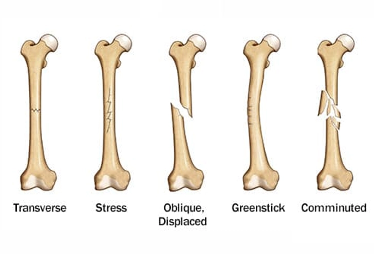 Types of Fractures Types of Fractures