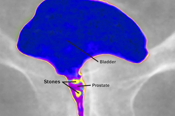 Prostate