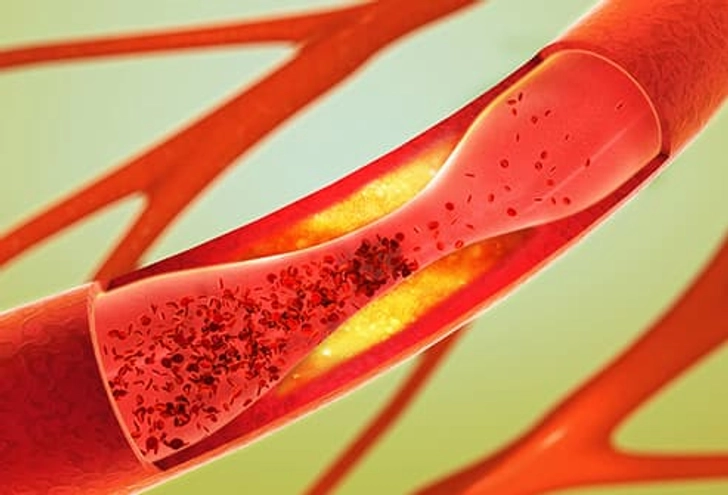 Cardiovascular Disease Cardiovascular Disease