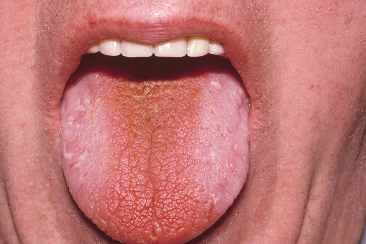 Polydipsia