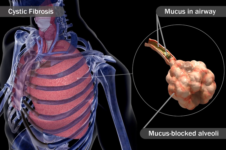 Cystic Fibrosis