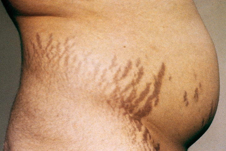 Cushing’s Syndrome