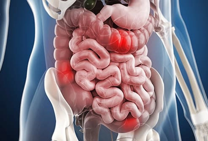 Irritable Bowel Syndrome Irritable Bowel Syndrome