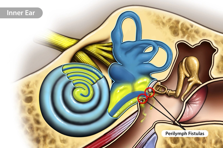 Perilymph Fistula