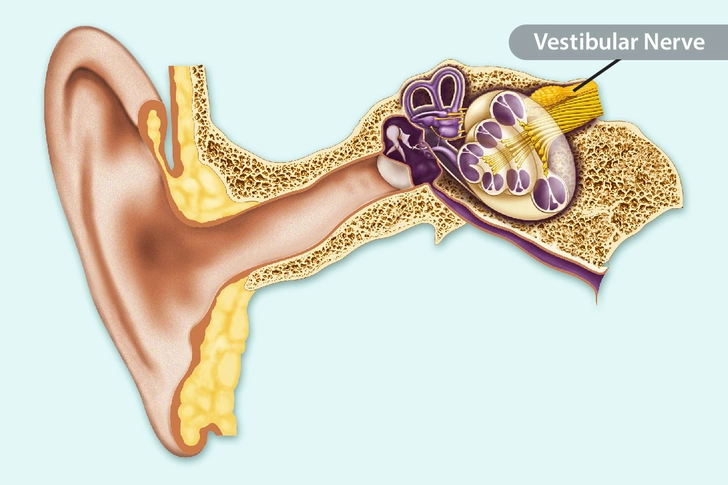 Vestibular Neuritis Vestibular Neuritis