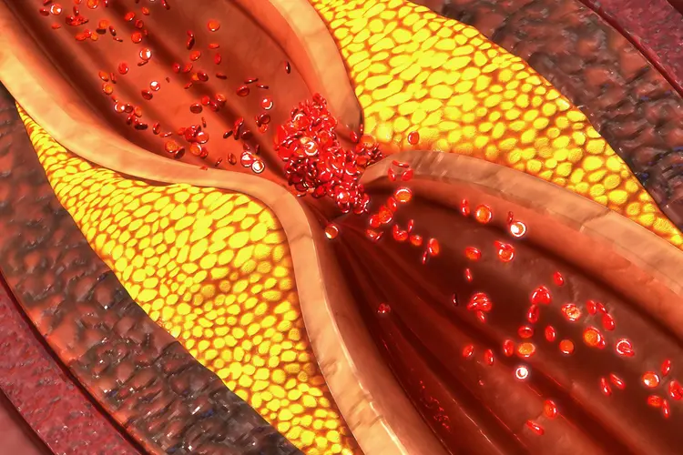 photo of clogged blood vessel