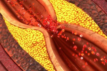 Atherosclerosis happens when there's too much plaque inside your arteries. It's what tends to cause heart attacks, strokes, and peripheral vascular disease. (Photo Credit: iStock/Getty Images)