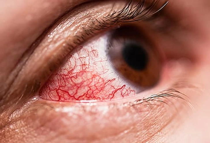 Pinkeye (Conjunctivitis)