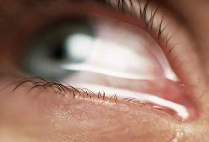 Something in Your Eye?