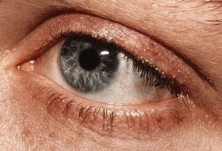 Blepharitis