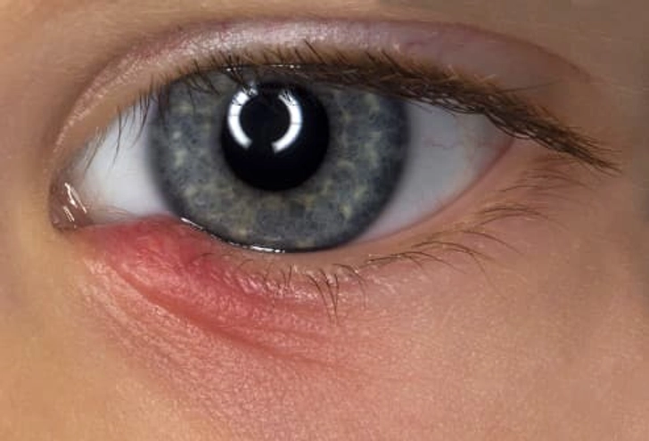 Blocked Tear Duct