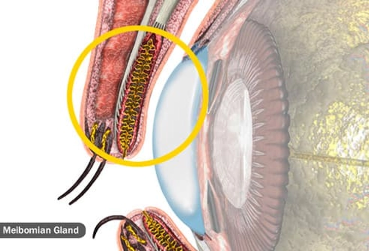 Problems With Oil Glands