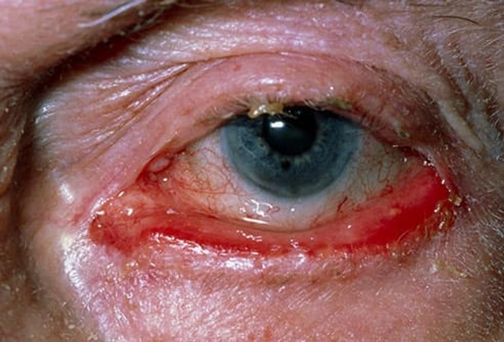 Eyelid Problems