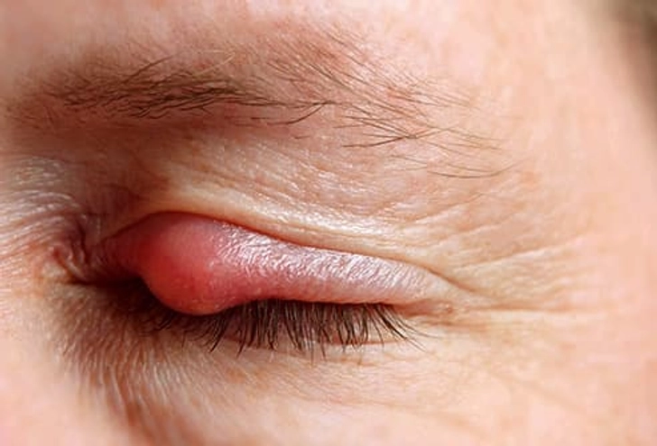 Styes