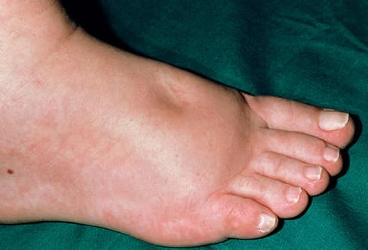 Pictures of Swollen Feet and Ankles