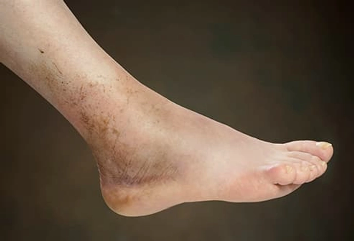 Injury