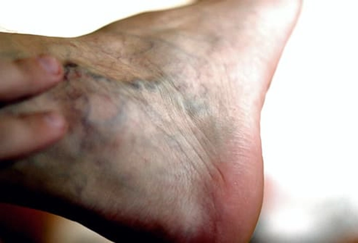 Chronic Venous Insufficiency Chronic Venous Insufficiency
